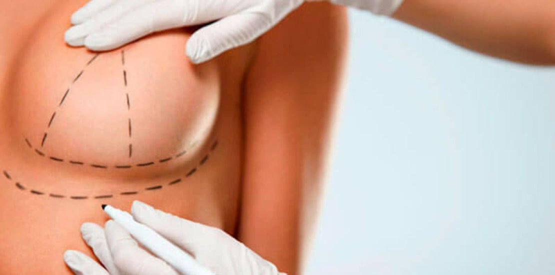 mamoplastia